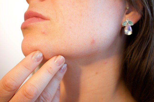 Come curarsi l’acne a 40 anni
