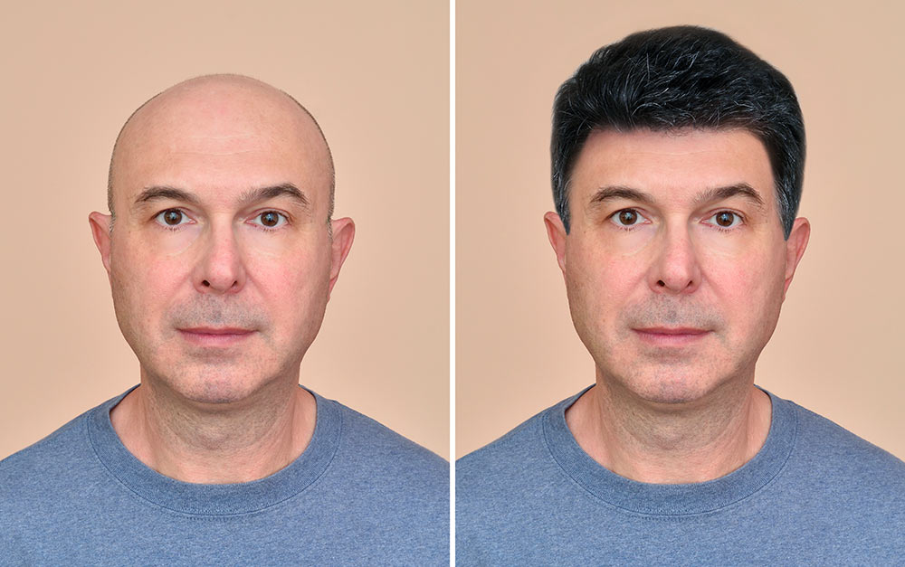 Patch cutaneo per capelli vantaggi e svantaggi Patch cutaneo per capelli vantaggi e svantaggi