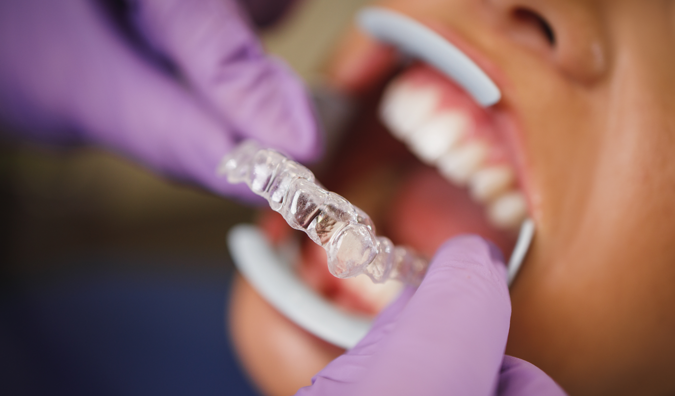 La rivoluzione nel campo dell’ortodonzia a Torino, con gli apparecchi invisibili