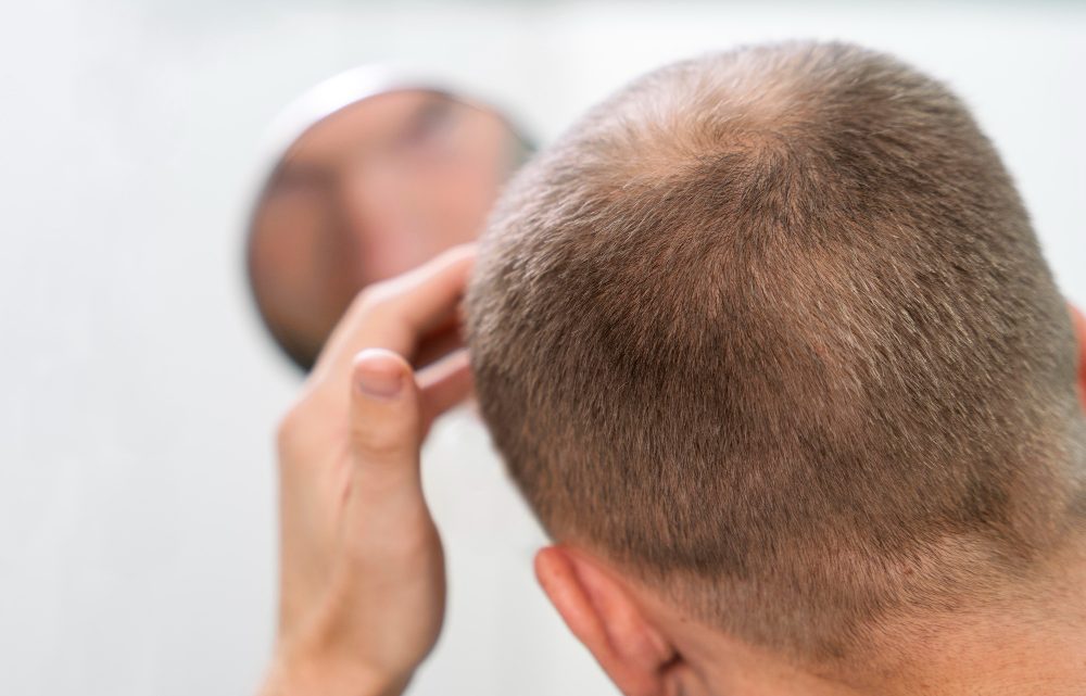 Protesi per capelli, come funziona e controindicazioni
