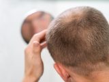 Protesi per capelli, come funziona e controindicazioni