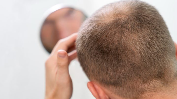 Protesi per capelli, come funziona e controindicazioni